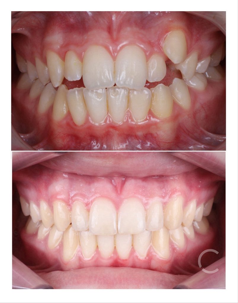DOMEmini before and after