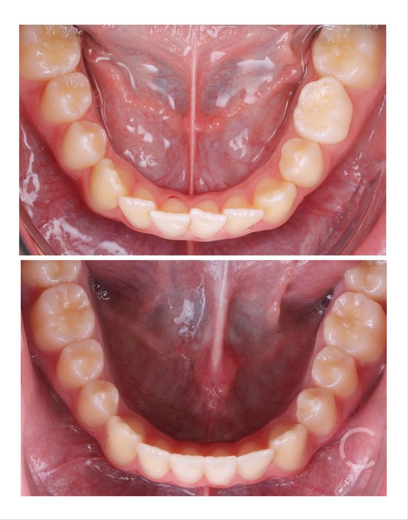DOMEmini before and after