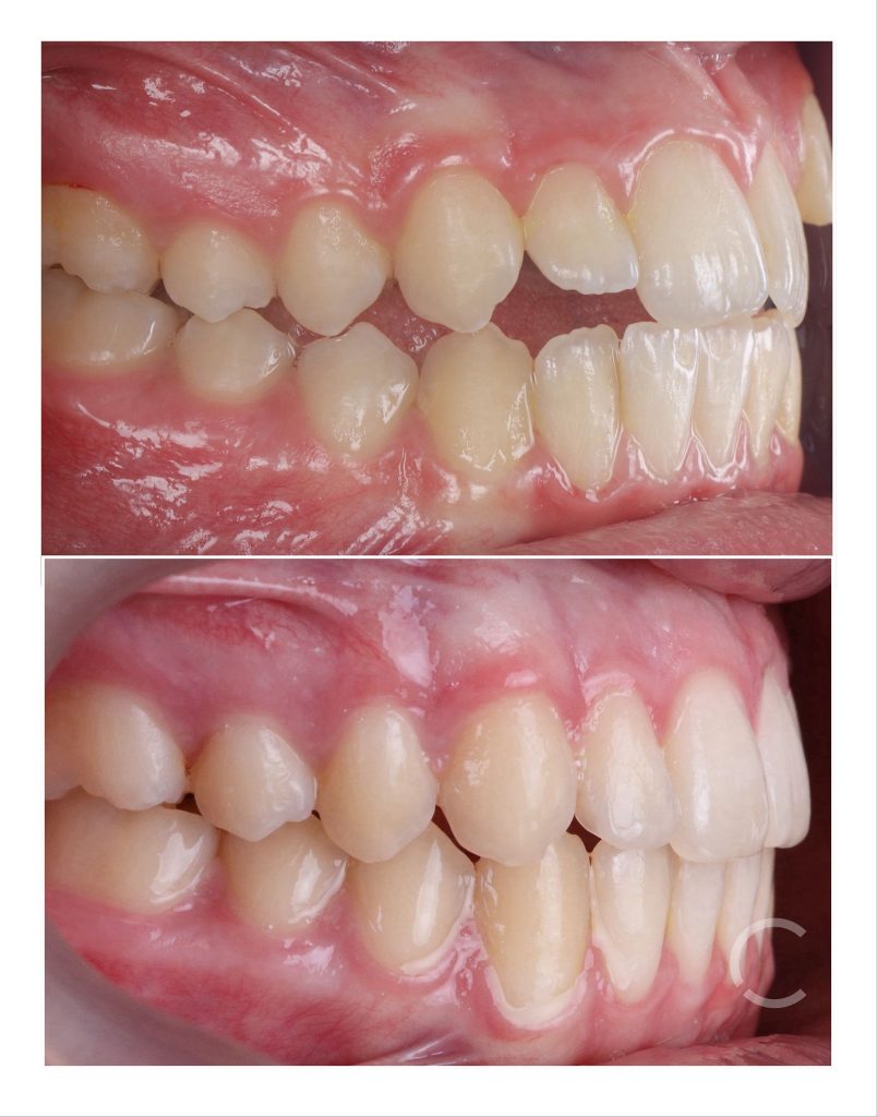 DOMEmini before and after