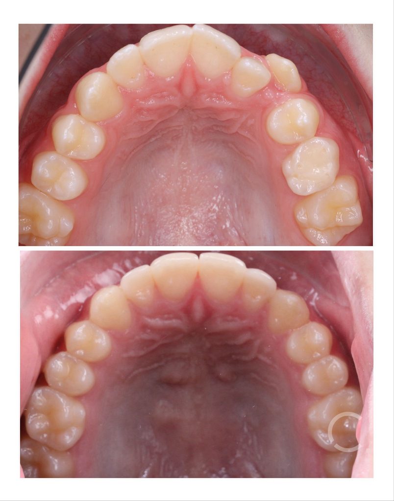 DOMEmini before and after