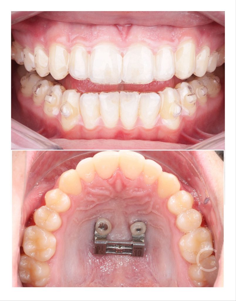 DOMEmini before and after