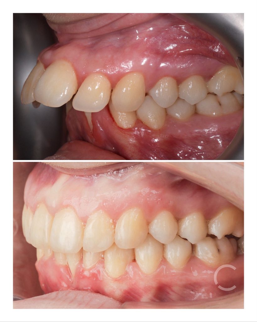 DOMEzero before and after 1