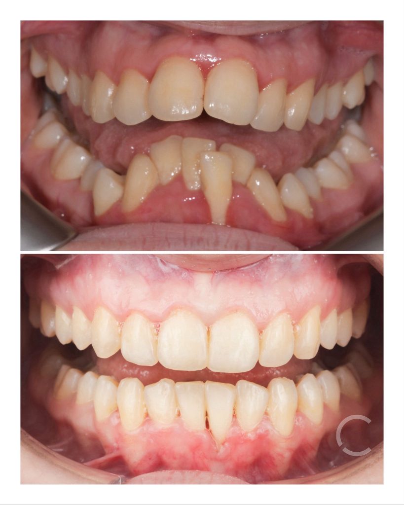 DOMEzero before and after 2