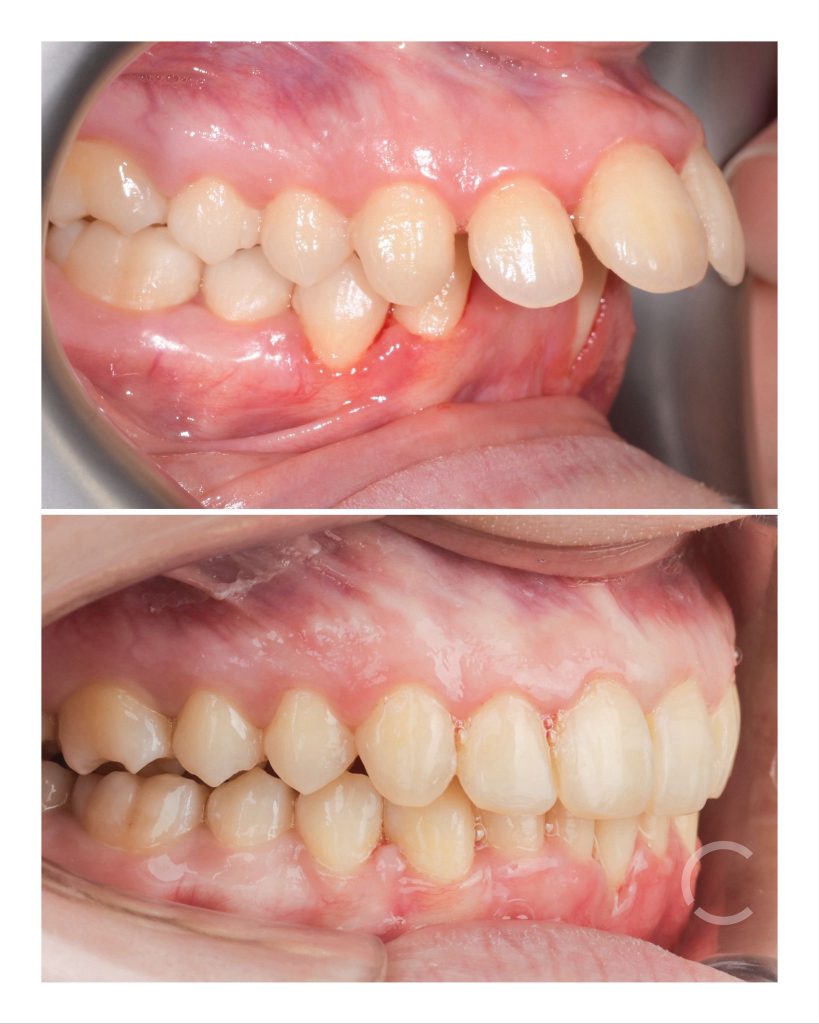 DOMEzero before and after 3