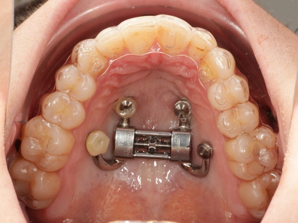 DOMEzero expander and clear aligners